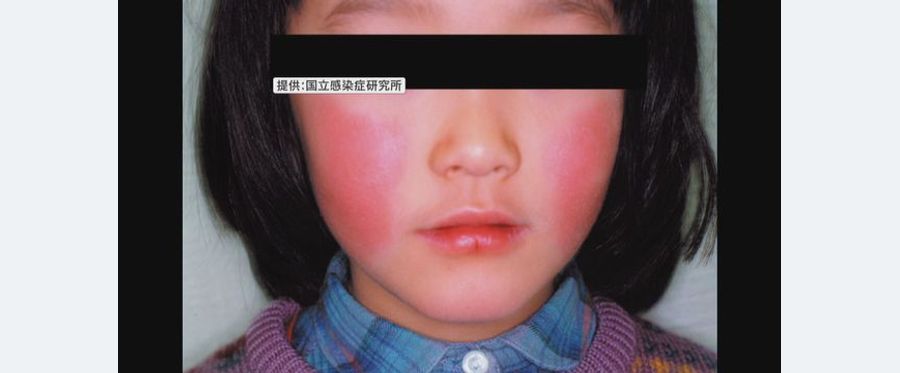 大阪府でリンゴ病患者急増、警報基準を超える